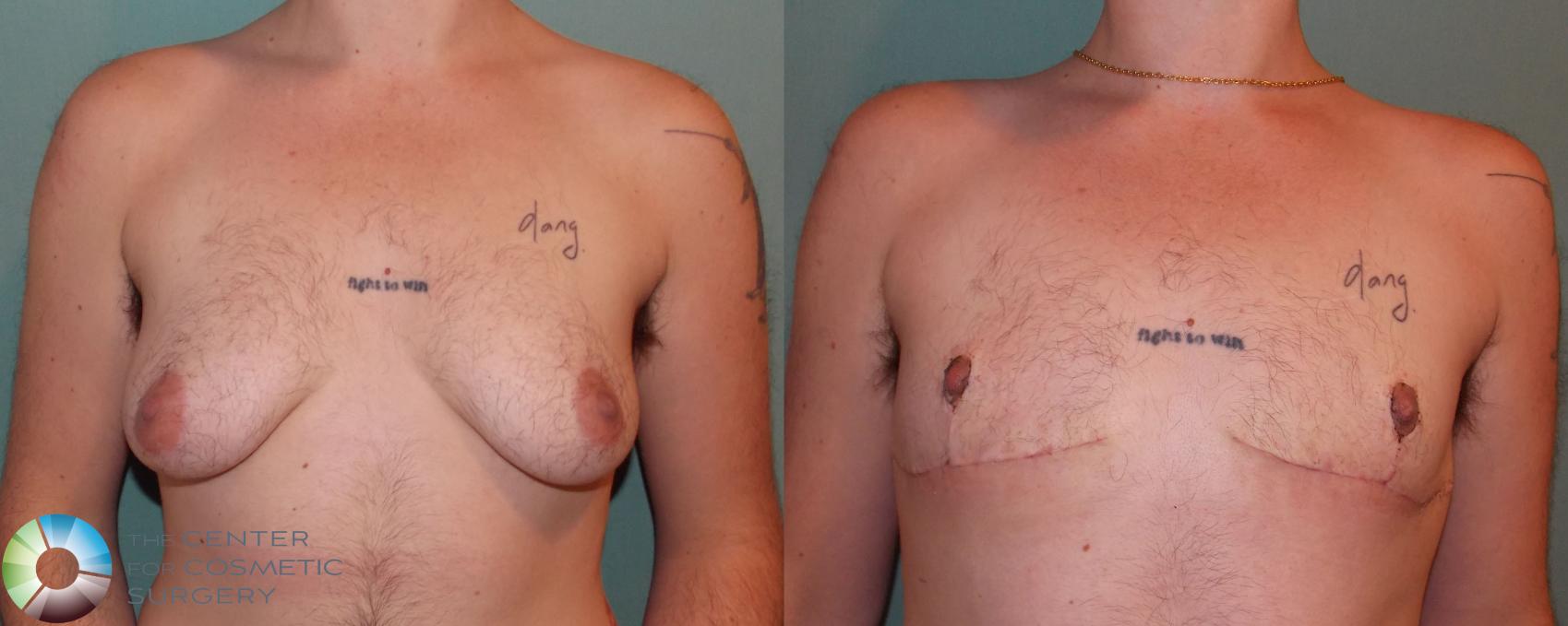 Before & After FTM Top Surgery/Chest Masculinization Case 11040 Anterior View in Golden, CO