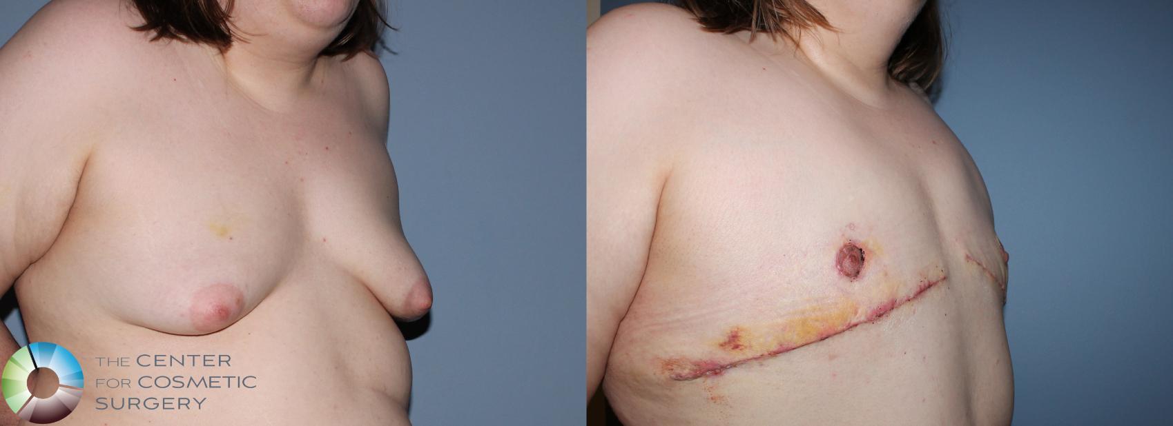 Before & After FTM Top Surgery/Chest Masculinization Case 11200 Right Oblique View in Golden, CO