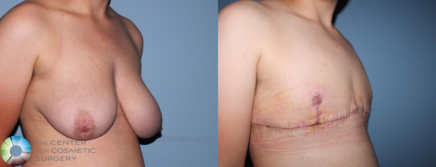 Before & After FTM Top Surgery/Chest Masculinization Case 11201 Right Oblique View in Golden, CO