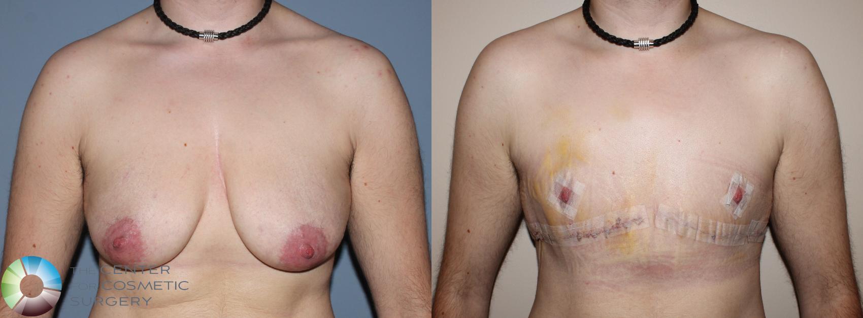 Before & After FTM Top Surgery/Chest Masculinization Case 11202 Front View in Golden, CO