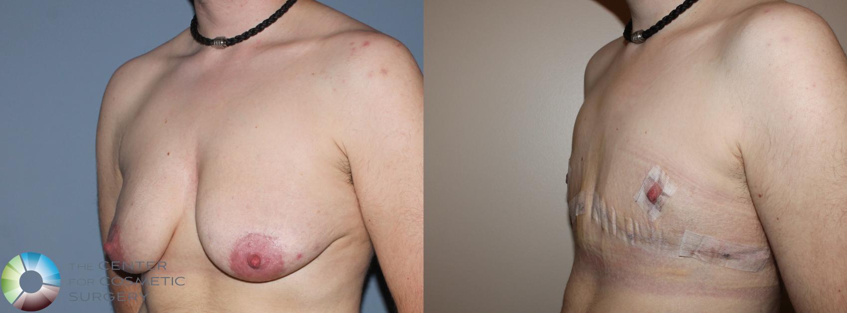 Before & After FTM Top Surgery/Chest Masculinization Case 11202 Left Oblique in Denver and Colorado Springs, CO