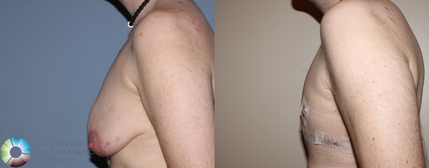 Before & After FTM Top Surgery/Chest Masculinization Case 11202 Left Side in Denver and Colorado Springs, CO