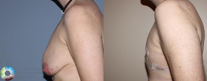 Before & After FTM Top Surgery/Chest Masculinization Case 11202 Left Side View in Golden, CO