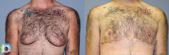 Before & After FTM Top Surgery/Chest Masculinization Case 11204 Front View in Golden, CO