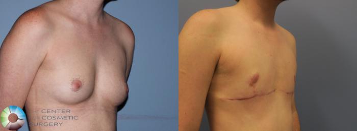 Before & After FTM Top Surgery/Chest Masculinization Case 11205 Right Oblique View in Golden, CO