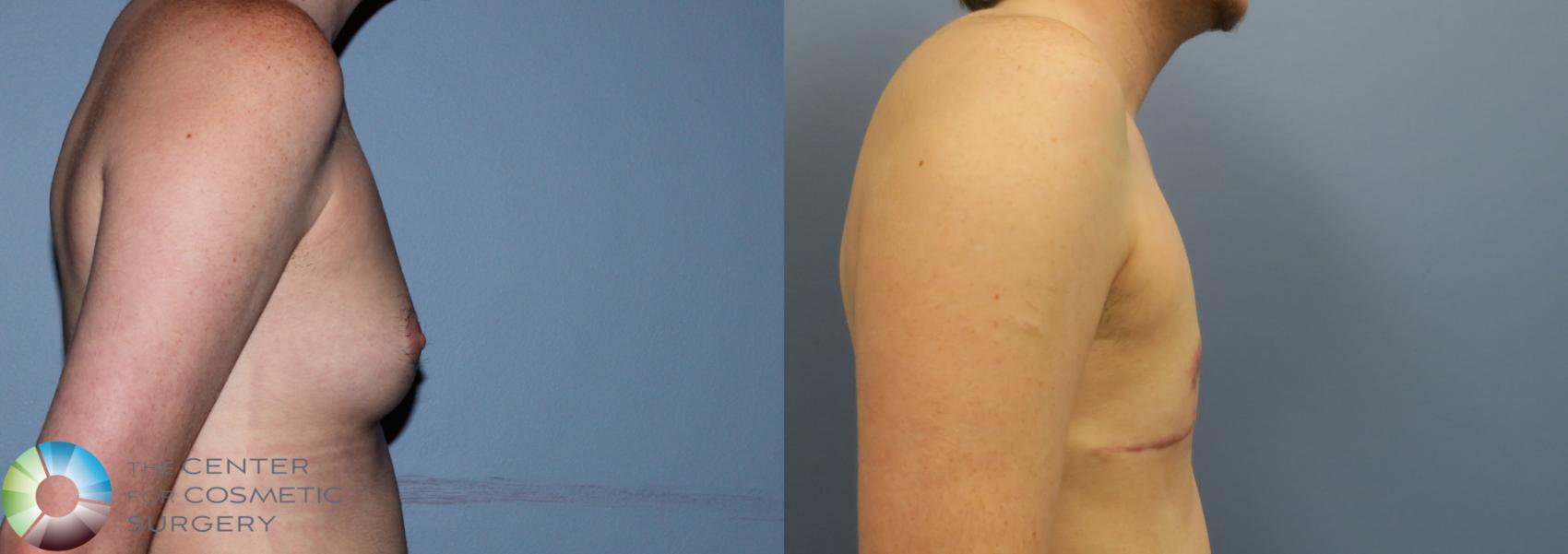 Before & After FTM Top Surgery/Chest Masculinization Case 11205 Right Side View in Golden, CO