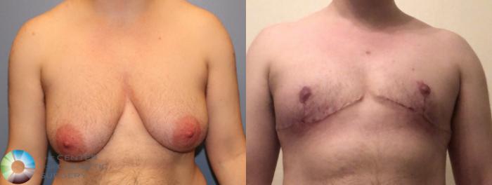 Before & After FTM Top Surgery/Chest Masculinization Case 11209 Front in Denver and Colorado Springs, CO