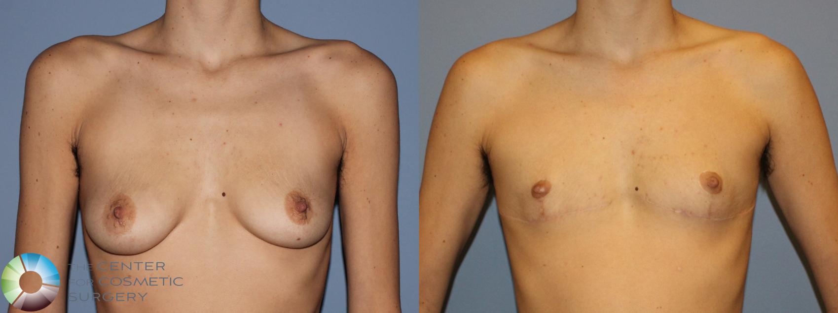 Before & After FTM Top Surgery/Chest Masculinization Case 11211 Front in Denver and Colorado Springs, CO