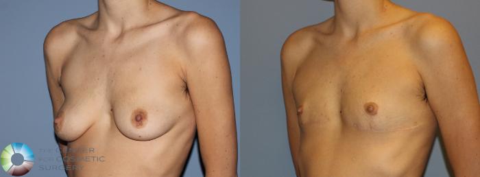 Before & After FTM Top Surgery/Chest Masculinization Case 11211 Left Oblique View in Golden, CO