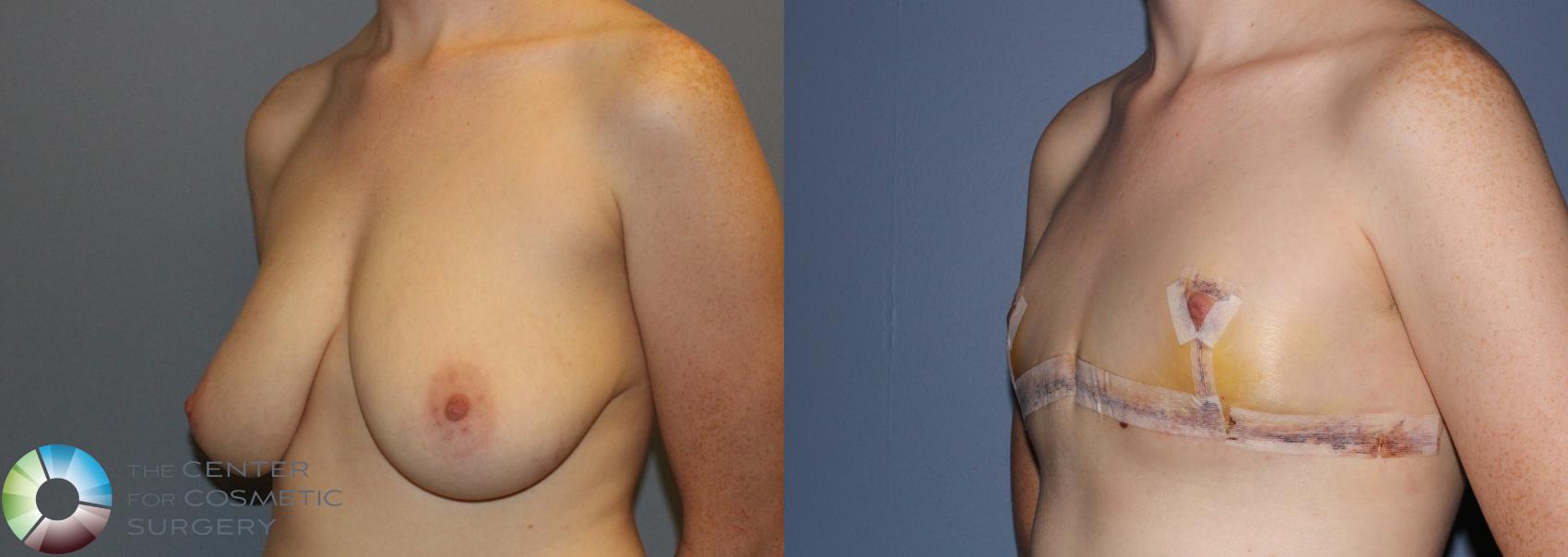 Before & After FTM Top Surgery/Chest Masculinization Case 11212 Left Oblique View in Golden, CO