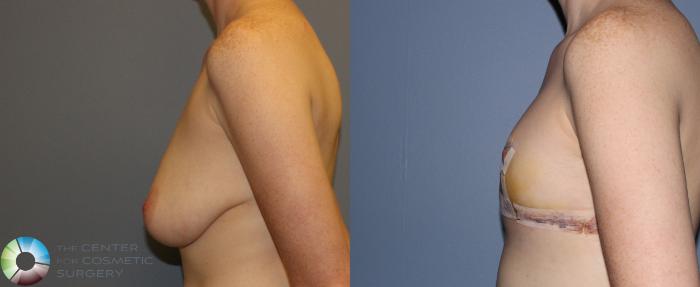 Before & After FTM Top Surgery/Chest Masculinization Case 11212 Left Side in Denver, CO