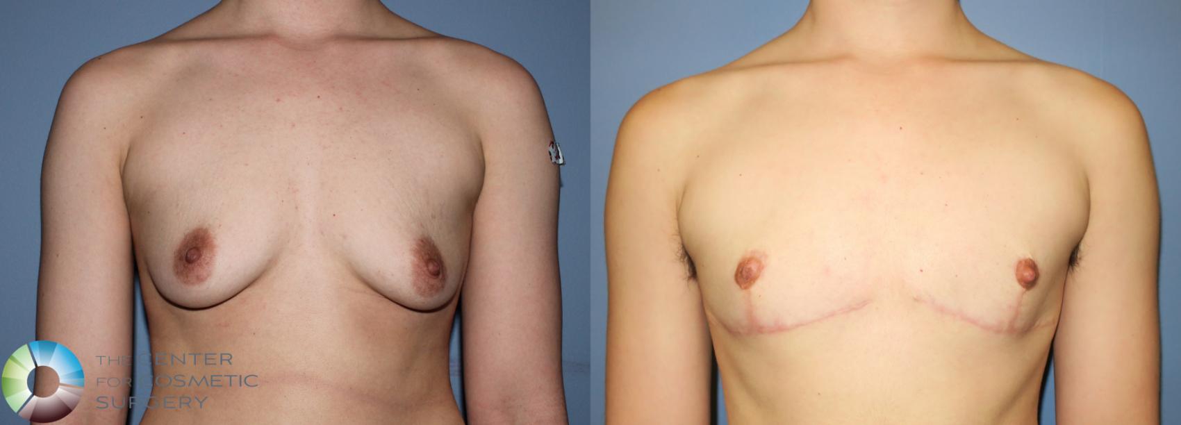 Before & After FTM Top Surgery/Chest Masculinization Case 11213 Front View in Golden, CO