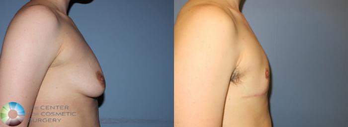Before & After FTM Top Surgery/Chest Masculinization Case 11213 Right Side View in Golden, CO