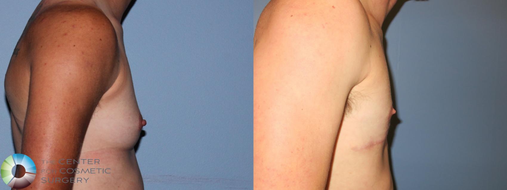 Before & After FTM Top Surgery/Chest Masculinization Case 11274 Right Side in Denver and Colorado Springs, CO