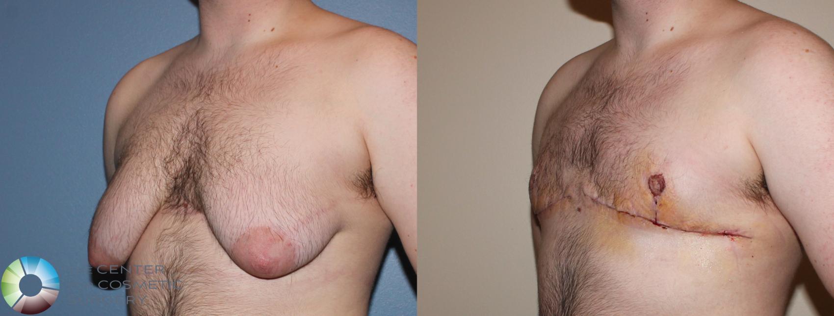 Before & After FTM Top Surgery/Chest Masculinization Case 11275 Left Oblique in Denver and Colorado Springs, CO
