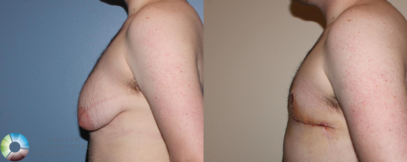 Before & After FTM Top Surgery/Chest Masculinization Case 11275 Left Side in Denver and Colorado Springs, CO