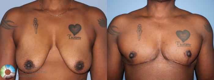 Before & After FTM Top Surgery/Chest Masculinization Case 11277 Front View in Golden, CO