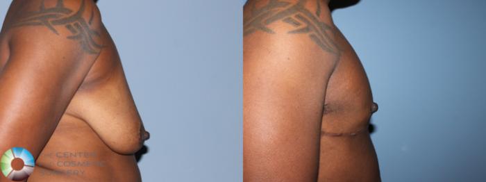 Before & After FTM Top Surgery/Chest Masculinization Case 11277 Right Side View in Golden, CO