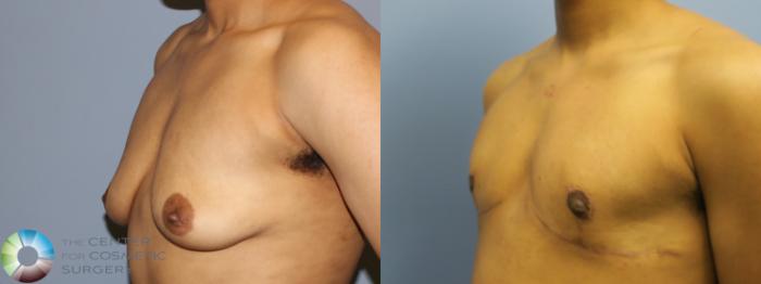 Before & After FTM Top Surgery/Chest Masculinization Case 11282 Left Oblique in Denver and Colorado Springs, CO