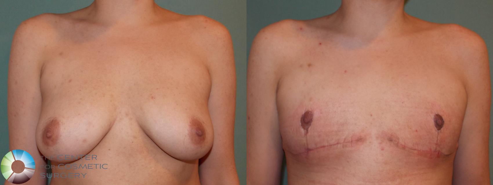 Before & After FTM Top Surgery/Chest Masculinization Case 11417 Front in Denver and Colorado Springs, CO