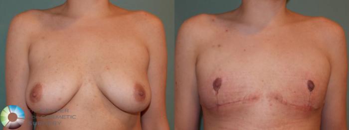 Before & After FTM Top Surgery/Chest Masculinization Case 11417 Front in Denver and Colorado Springs, CO