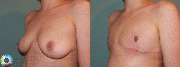 Before & After FTM Top Surgery/Chest Masculinization Case 11417 Left Oblique in Denver and Colorado Springs, CO