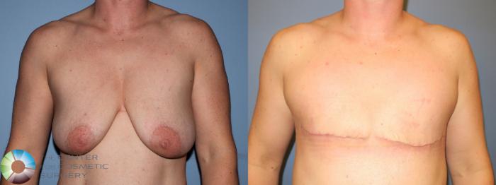 Before & After FTM Top Surgery/Chest Masculinization Case 11418 Front View in Golden, CO