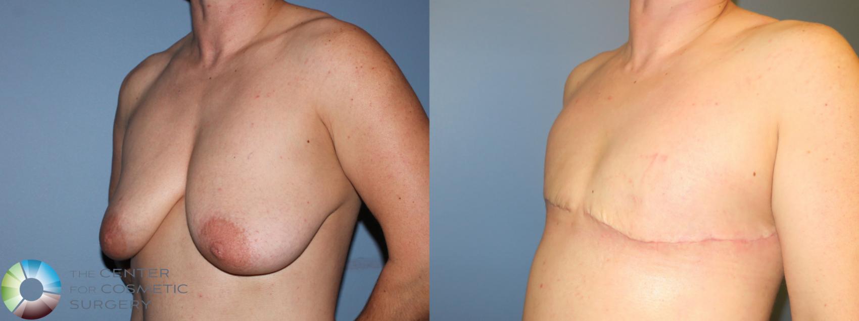 Before & After FTM Top Surgery/Chest Masculinization Case 11418 Left Oblique in Denver and Colorado Springs, CO