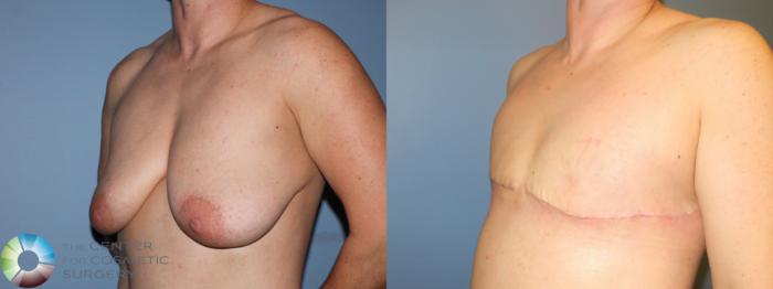 Before & After FTM Top Surgery/Chest Masculinization Case 11418 Left Oblique View in Golden, CO