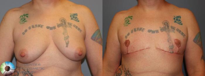 Before & After FTM Top Surgery/Chest Masculinization Case 11419 Front in Denver and Colorado Springs, CO