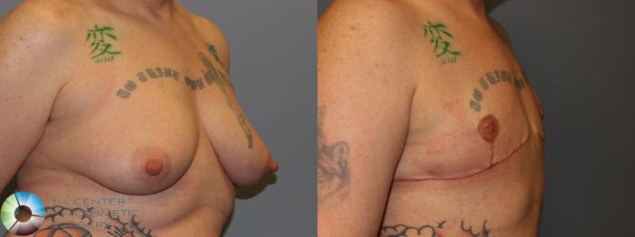 Before & After FTM Top Surgery/Chest Masculinization Case 11419 Right Oblique in Denver and Colorado Springs, CO