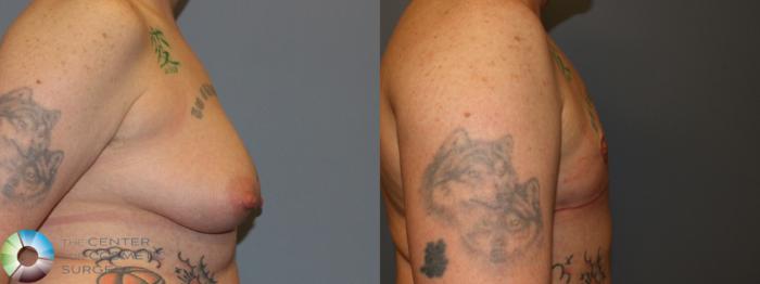 Before & After FTM Top Surgery/Chest Masculinization Case 11419 Right Side in Denver and Colorado Springs, CO