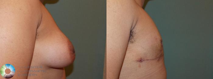 Before & After FTM Top Surgery/Chest Masculinization Case 11424 Right Side View in Golden, CO