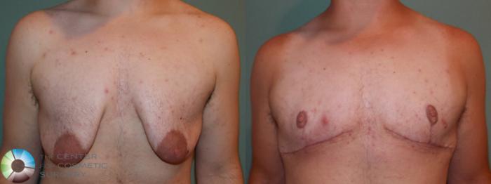 Before & After FTM Top Surgery/Chest Masculinization Case 11425 Front View in Golden, CO