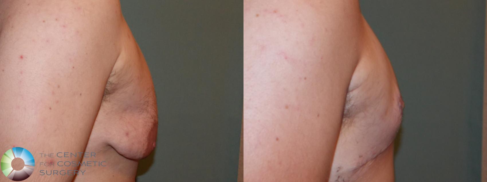 Before & After FTM Top Surgery/Chest Masculinization Case 11425 Right Side in Denver and Colorado Springs, CO