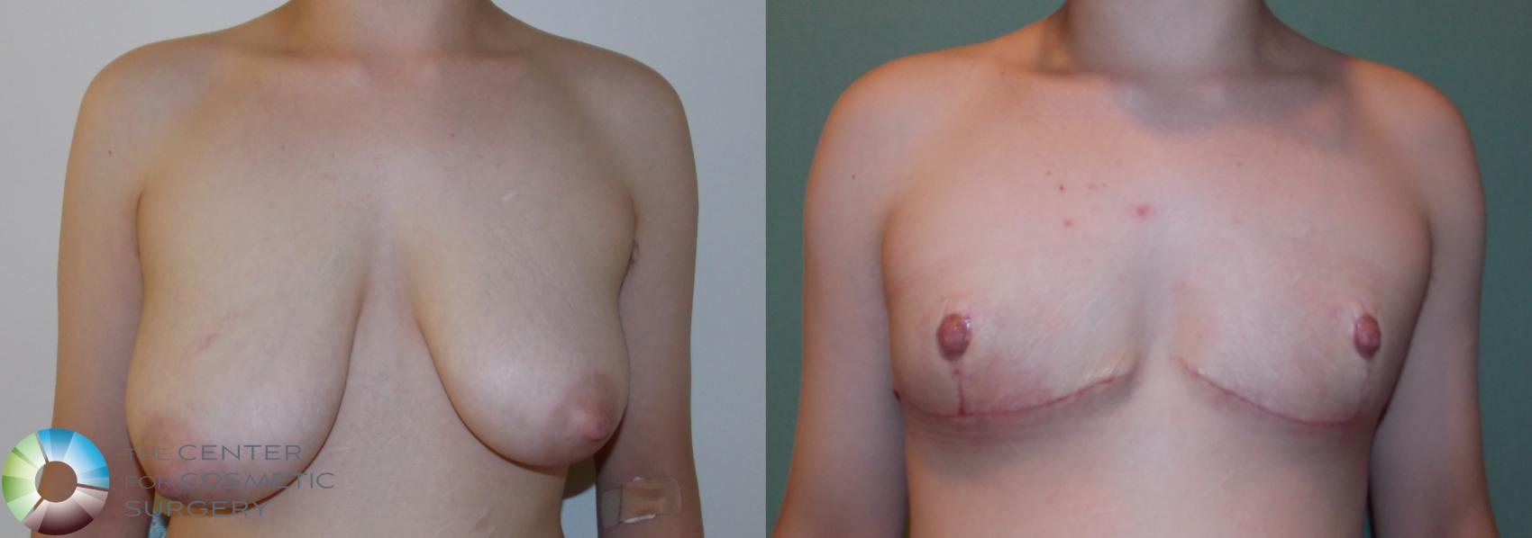 Before & After FTM Top Surgery/Chest Masculinization Case 11426 Front View in Golden, CO