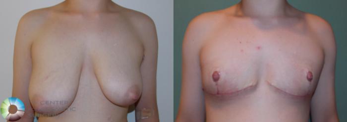 Before & After FTM Top Surgery/Chest Masculinization Case 11426 Front View in Golden, CO