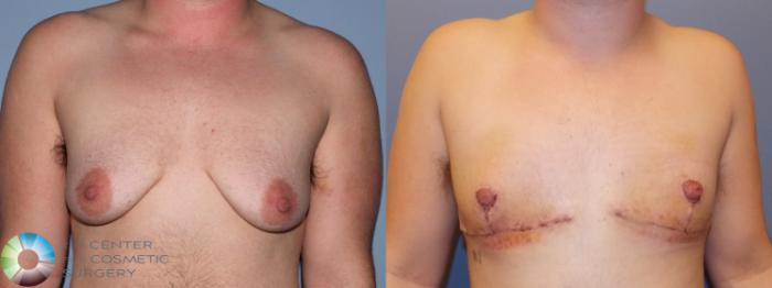 Before & After FTM Top Surgery/Chest Masculinization Case 11428 Front in Denver and Colorado Springs, CO