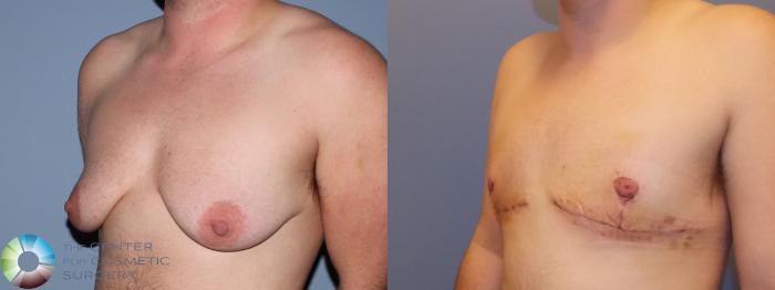 Before & After FTM Top Surgery/Chest Masculinization Case 11428 Left Oblique in Denver and Colorado Springs, CO