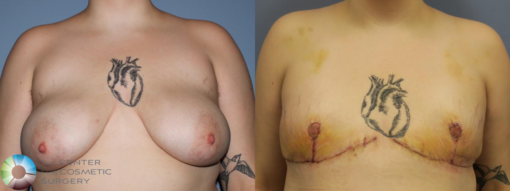 Before & After FTM Top Surgery/Chest Masculinization Case 11429 Front in Denver and Colorado Springs, CO