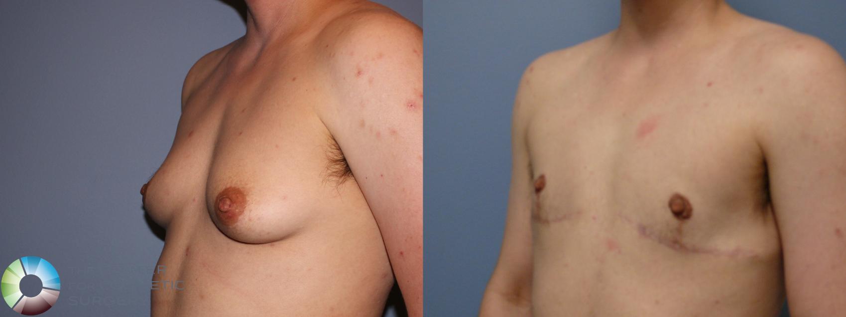 Before & After FTM Top Surgery/Chest Masculinization Case 11431 Left Oblique in Denver and Colorado Springs, CO