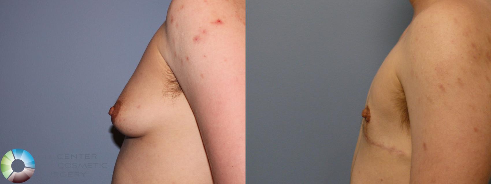 Before & After FTM Top Surgery/Chest Masculinization Case 11431 Left Side in Denver and Colorado Springs, CO