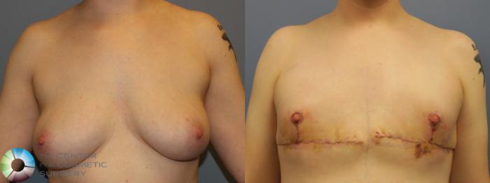 Before & After FTM Top Surgery/Chest Masculinization Case 11432 Front in Denver and Colorado Springs, CO
