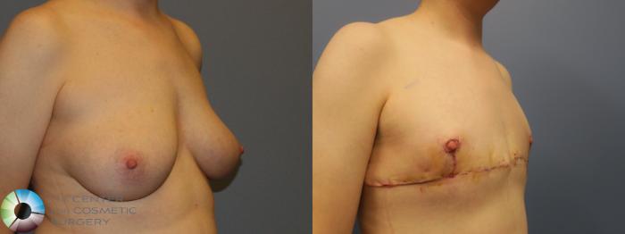 Before & After FTM Top Surgery/Chest Masculinization Case 11432 Right Oblique in Denver and Colorado Springs, CO