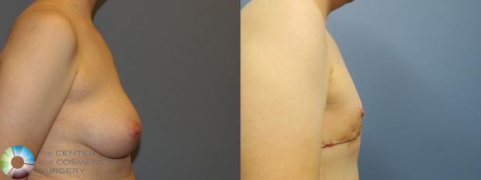 Before & After FTM Top Surgery/Chest Masculinization Case 11432 Right Side in Denver and Colorado Springs, CO