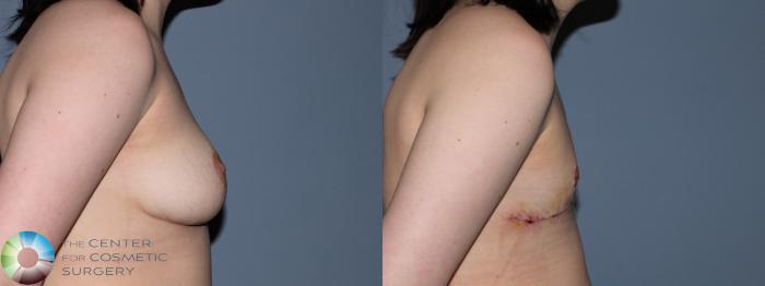 Before & After FTM Top Surgery/Chest Masculinization Case 11433 Left Side View in Golden, CO
