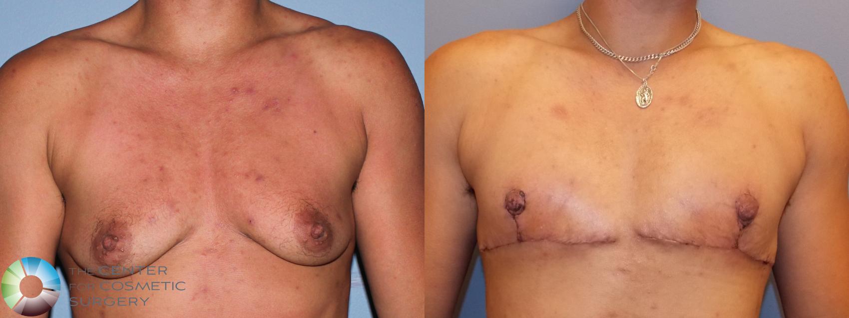 Before & After FTM Top Surgery/Chest Masculinization Case 11434 Front View in Golden, CO