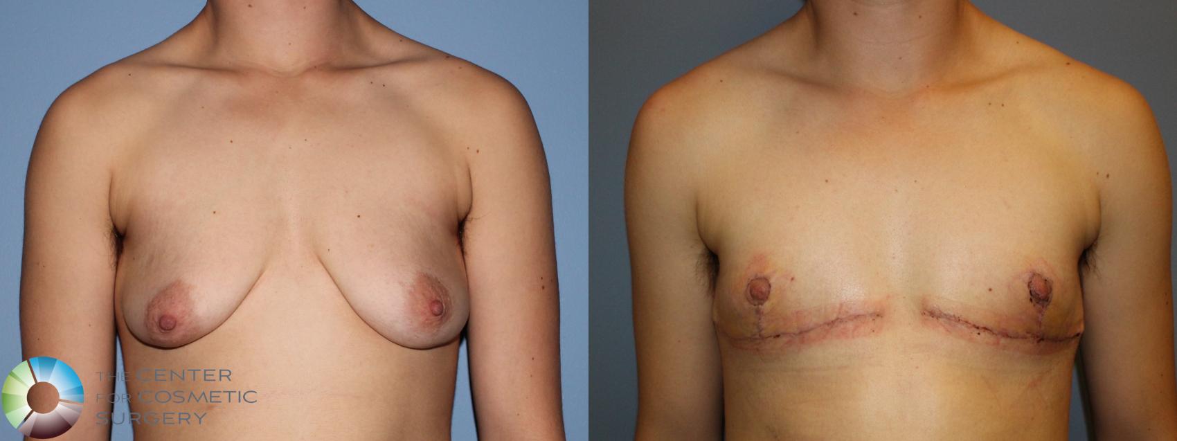 Before & After FTM Top Surgery/Chest Masculinization Case 11435 Front View in Golden, CO