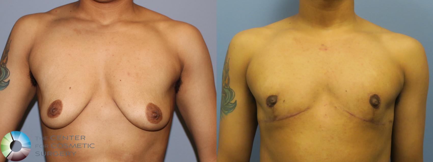 Before & After FTM Top Surgery/Chest Masculinization Case 11439 Front in Denver and Colorado Springs, CO