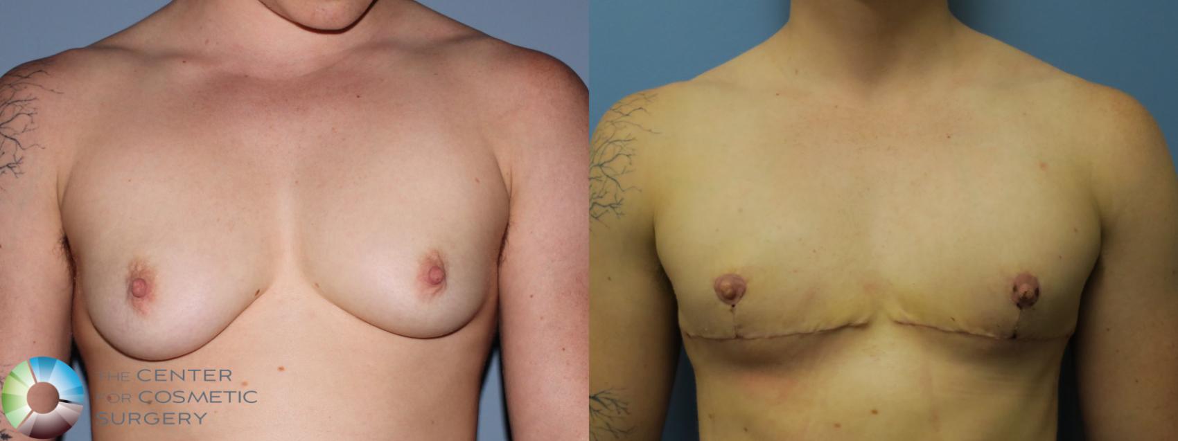 Before & After FTM Top Surgery/Chest Masculinization Case 11442 Front in Denver and Colorado Springs, CO